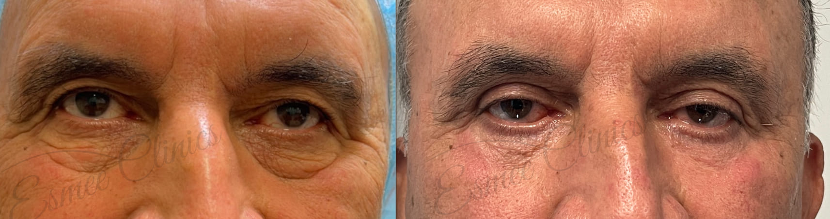 Before and After img